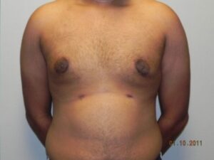 After Image: Male Breast Reduction