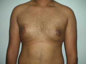 Before Image: Male Breast Reduction