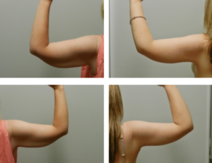 Get Rid of Flabby Underarms 