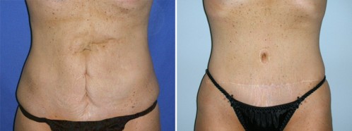 What Kind of Tummy Tuck Scar Should I Expect?