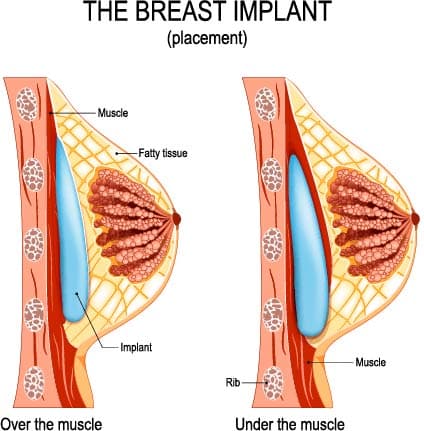 breast implant National Harbor MD