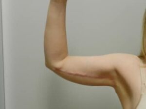 After Image: Arm Lift
