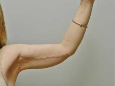 After Image: Arm Lift - front