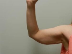 Before Image: Arm Lift