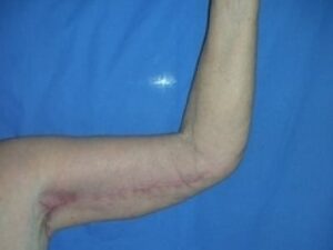 After Image: Arm Lift