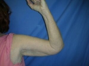 Before Image: Arm Lift