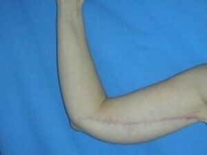 After Image: Arm Lift