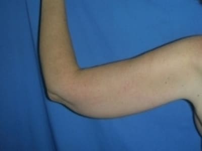 After Image: Arm Lift - back