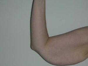 Before Image: Arm Lift