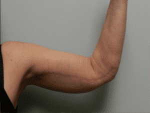After Image: Arm Lift