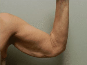 Before Image: Arm Lift