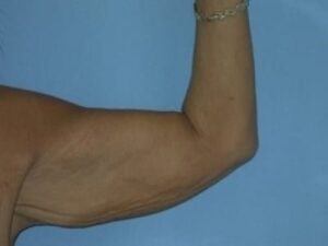 Before Image: Arm Lift