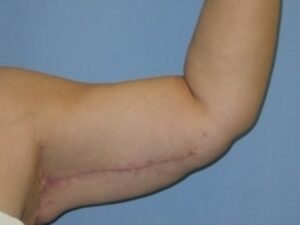After Image: Arm Lift