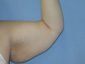 Before Image: Arm Lift