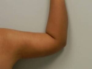 After Image: Arm Lift