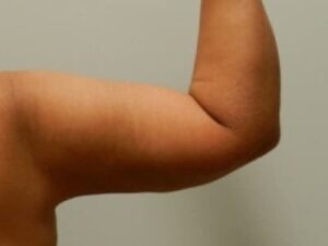After Image: Arm Lift