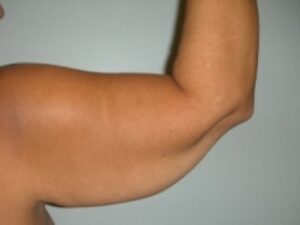 Before Image: Arm Lift