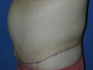 After Image: After Weight Loss