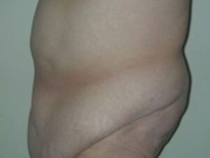 Before Image: After Weight Loss