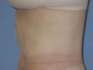 After Image: After Weight Loss