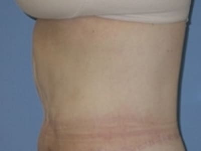 After Image: After Weight Loss - left-side