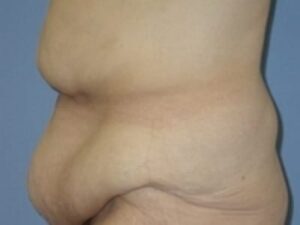 Before Image: After Weight Loss