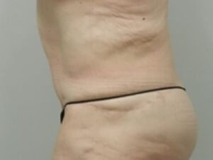 After Image: After Weight Loss