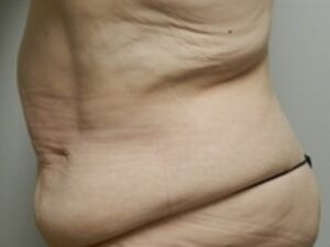 Before Image: After Weight Loss