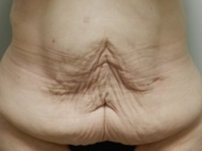 Before Image: After Weight Loss - front