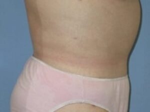 After Image: After Weight Loss