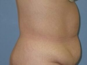 Before Image: After Weight Loss