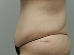 After Image: After Weight Loss