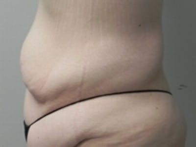 Before Image: After Weight Loss - left-side