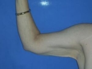 After Image: Arm Lipo