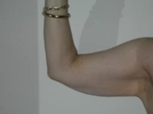 Before Image: Arm Lipo