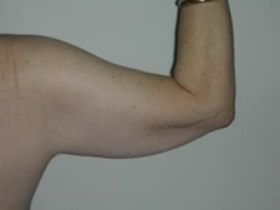 Before Image: Arm Lipo - back