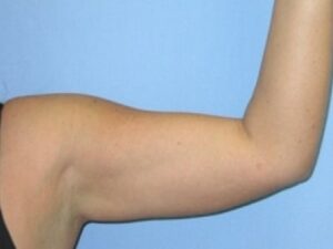 After Image: Arm Lipo