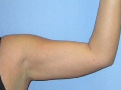 After Image: Arm Lipo - front