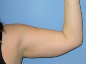 Before Image: Arm Lipo
