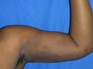 After Image: Arm Lipo