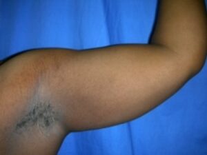 Before Image: Arm Lipo