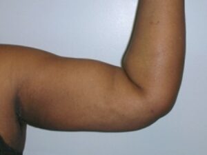 After Image: Arm Lipo