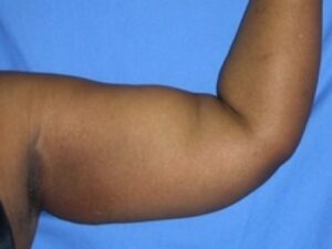 Before Image: Arm Lipo