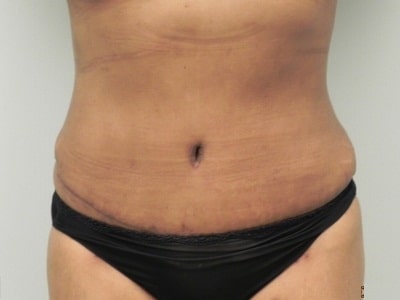 After Image: Bella Body Lift - front