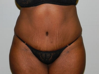 After Image: Bella Body Lift - front