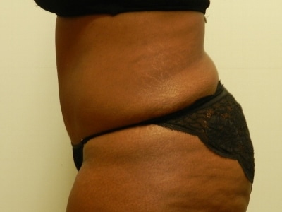 After Image: Bella Body Lift - left-side