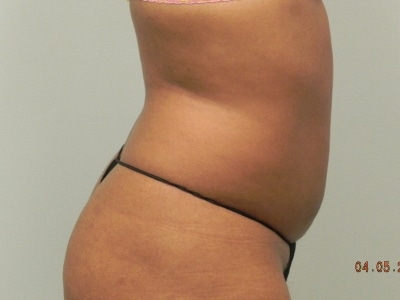 Before Image: Bella Body Lift - right-side