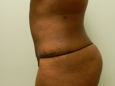 After Image: Bella Body Lift - left-side