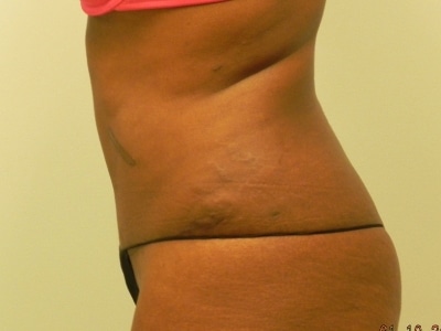 After Image: Bella Body Lift - left-side