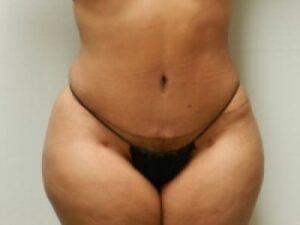 After Image: Bella Body Lift
